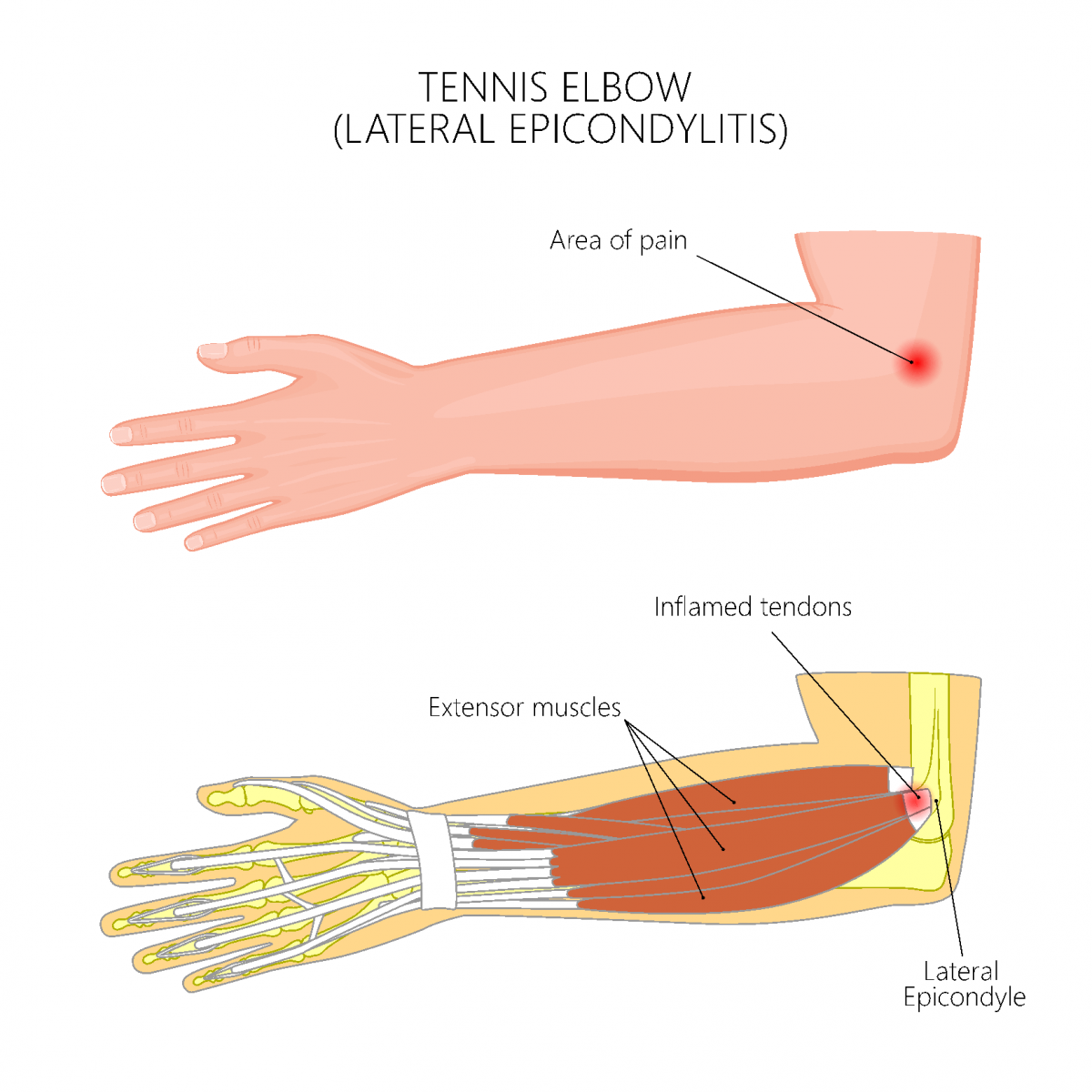 Tennis Elbow Surgery